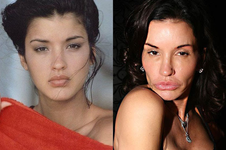 Les pires ratés des stars en chirurgie esthétique