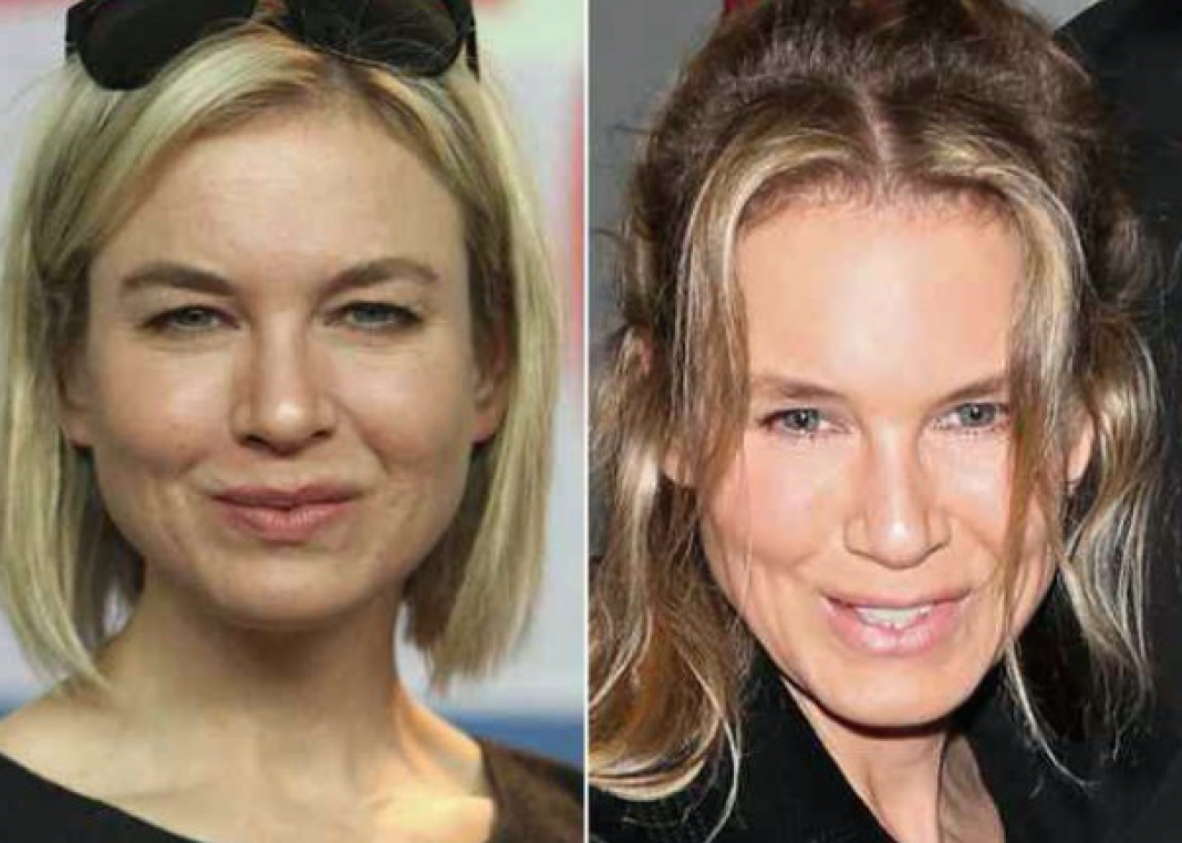 Les pires ratés des stars en chirurgie esthétique