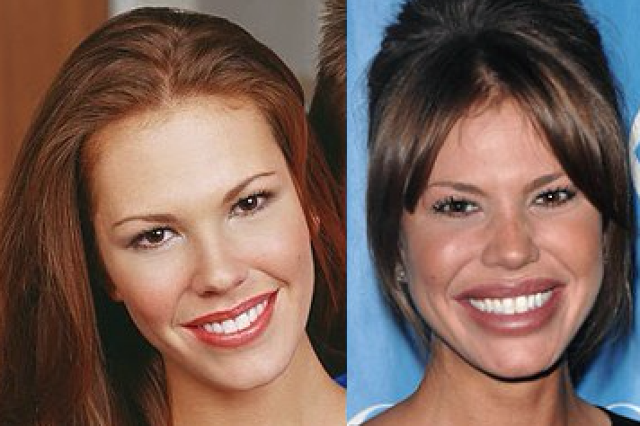 Les pires ratés des stars en chirurgie esthétique