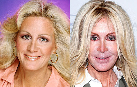 Les pires ratés des stars en chirurgie esthétique