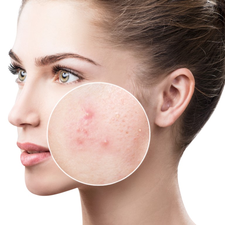 limiter les imperfections propres à l'acné