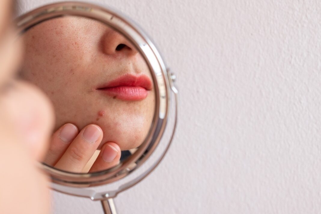 acné produits anti imperfections