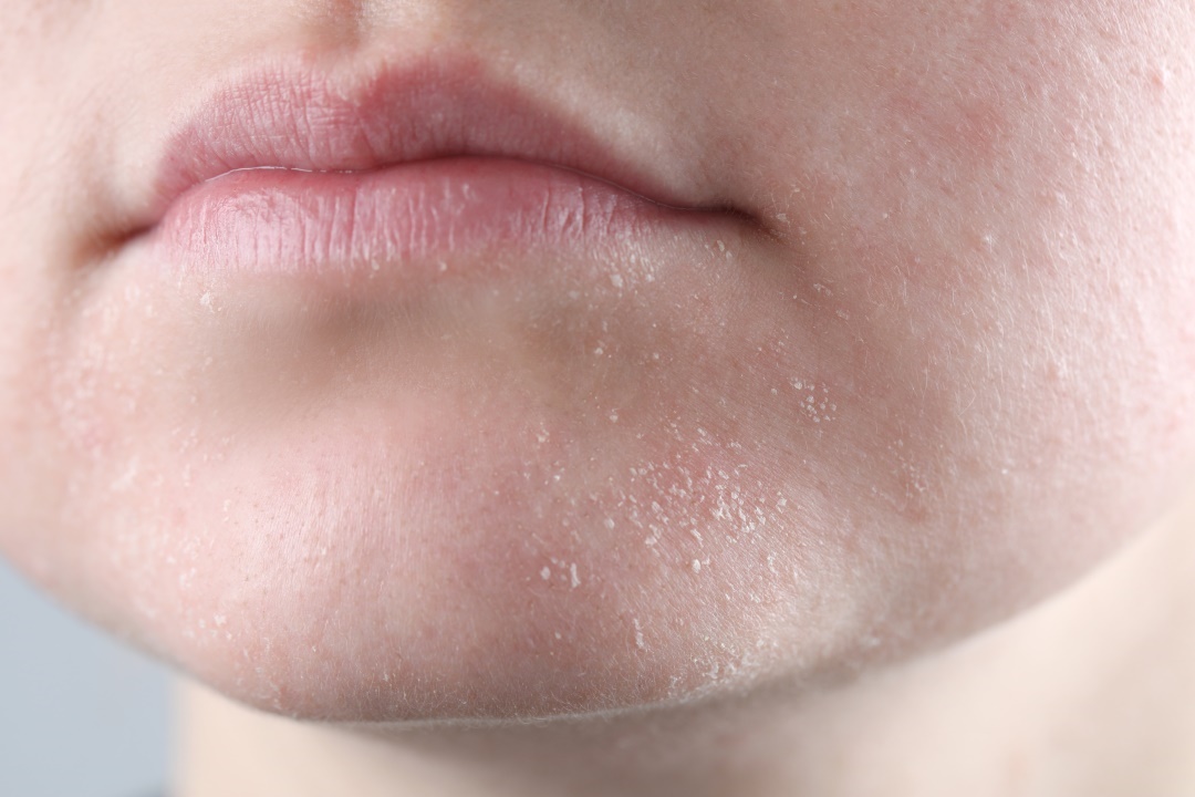 plaques peau seches visage causes solution soins